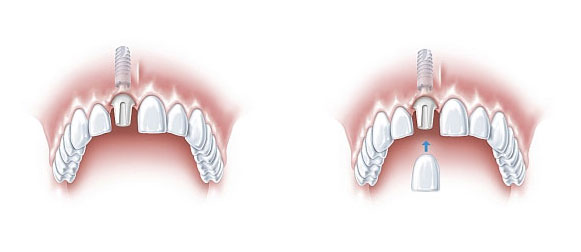 odbudowa zęba szczecin 2