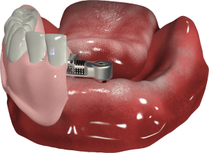 proteza na belce w żuchwie i dwa implanty