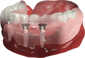 proteza na implantach w żuchwie - 4 x Locator