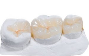 Ceramiczna rekonstrukcja - odbudowa zęba odtwarzają w idealny sposób jego kształt anatomiczny