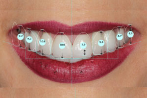 Cyfrowa analiza uśmiechu to projektowanie nowych kształtów nowych zębów z niezwykłą precyzją
