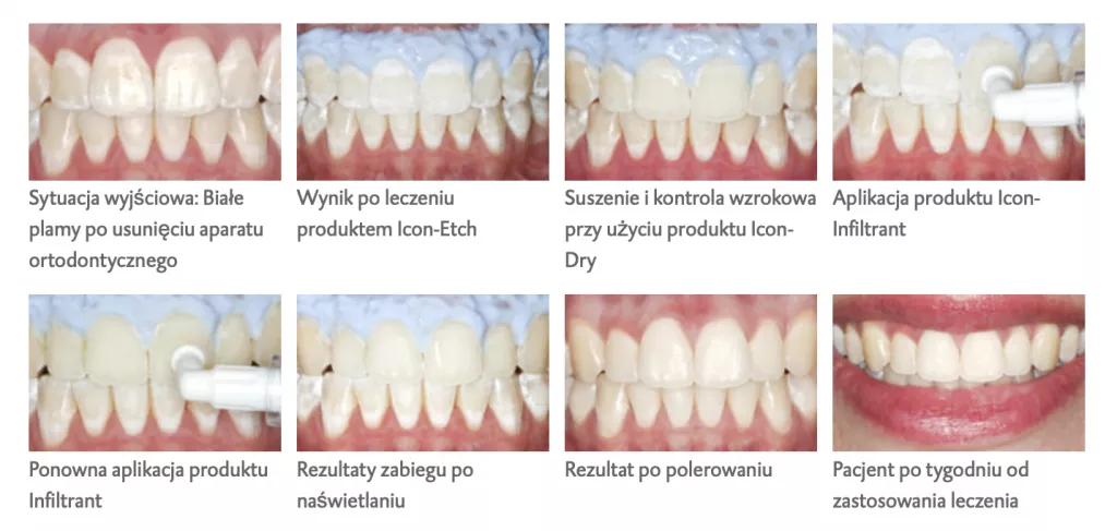 ICON-efekty-leczenia-stomatologia-na-podzamczu