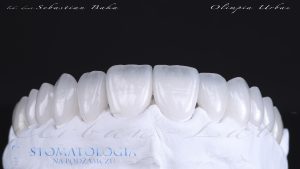 Licówki ceramiczne pozwalają na stworzenie zupełnie nowych kształtów zębów w pięknym, jednym kolorze